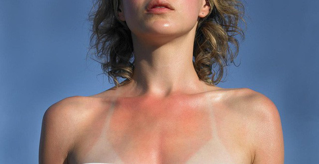 Tác hại của tia UV trên da